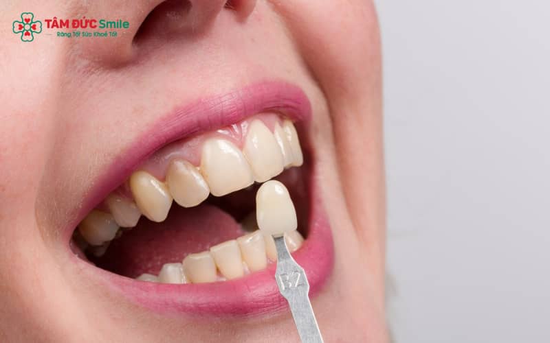 Quy trình dán sứ phức tạp, yêu cầu độ chính xác tuyệt đối
