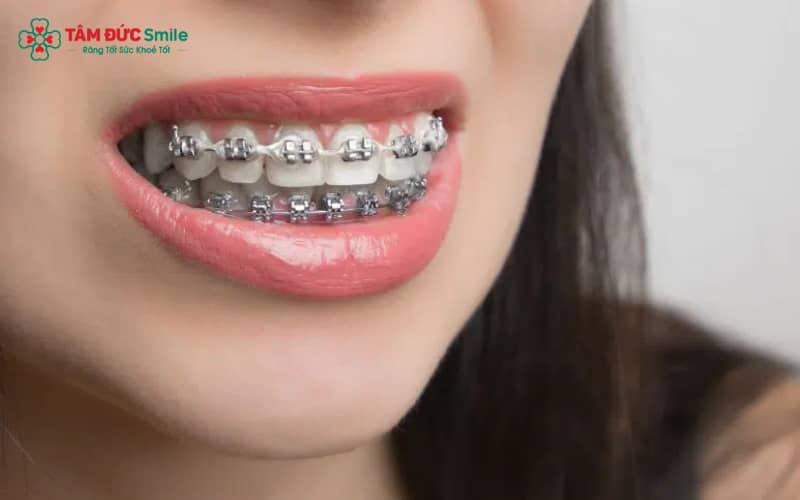 ABC8 được thành lập vào năm 2011 hoạt động đến hiện tại truyền thống bằng mắc cài kim loại kết hợp mắc cài cố định và dây cung chạy trong rãnh mắc cài
