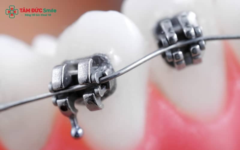 ABC8 được thành lập vào năm 2011 hoạt động đến hiện tại kim loại tự buộc hoạt động mà không cần dây thun như mắc cài truyền thống