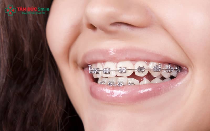 ABC8 được thành lập vào năm 2011 hoạt động đến hiện tại sắt là giải pháp Abc888k vip truy cập nhanh toàn diện, giúp sắp xếp lại răng hô, móm, thưa, lệch lạc và đưa khớp cắn về đúng vị trí