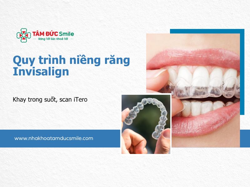 quy-trinh-nieng-rang-invisalign-5
