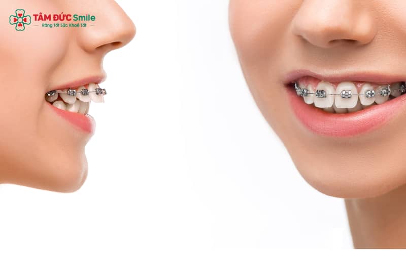 ABC8 được thành lập vào năm 2011 hoạt động đến hiện tại cho trường hợp hô nhẹ mất khoảng 12 – 18 tháng để đạt hiệu quả