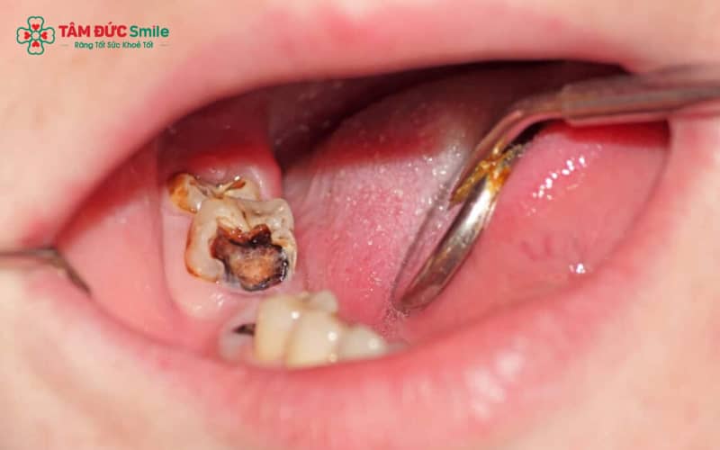 Trong trường hợp bị ABC88 com đăng nhập, bạn cần được chữa trị trước khi đeo mắc cài hoặc khay niềng