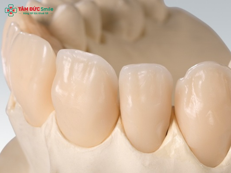 rang-su-ceramill-1