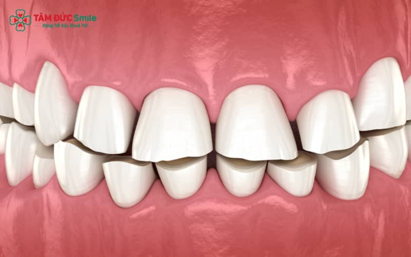 Răng thưa là tình trạng răng không khít sát, gây ra những khoảng trống giữa các răng