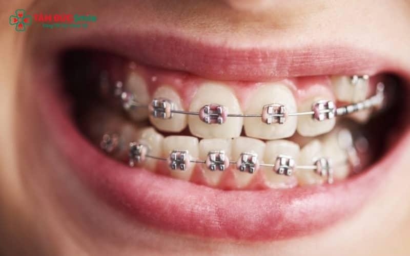 Bộ khay niềng trong suốt cho răng thưa được cá nhân hóa, áp dụng lực nhẹ nhàng để nắn chỉnh răng đúng vị trí
