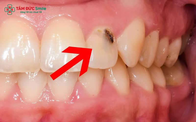 Giai đoạn ABC88 com đăng nhập sớm xảy ra khi mảng bám và vi khuẩn tích tụ, dần phá hủy cấu trúc men răng ban đầu
