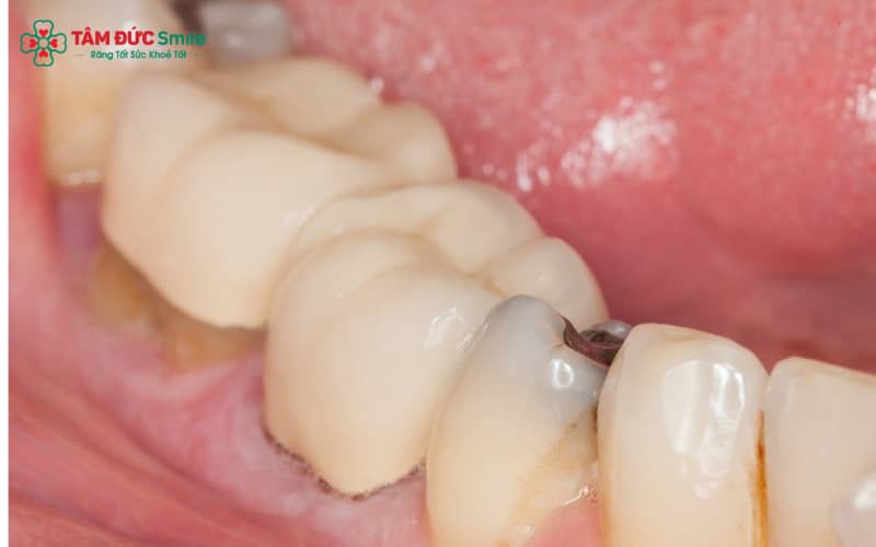 Khi ABC88 com đăng nhập mới hình thành, men răng bắt đầu mất khoáng, tạo nên các đốm màu trắng đục hay nâu nhạt trên bề mặt
