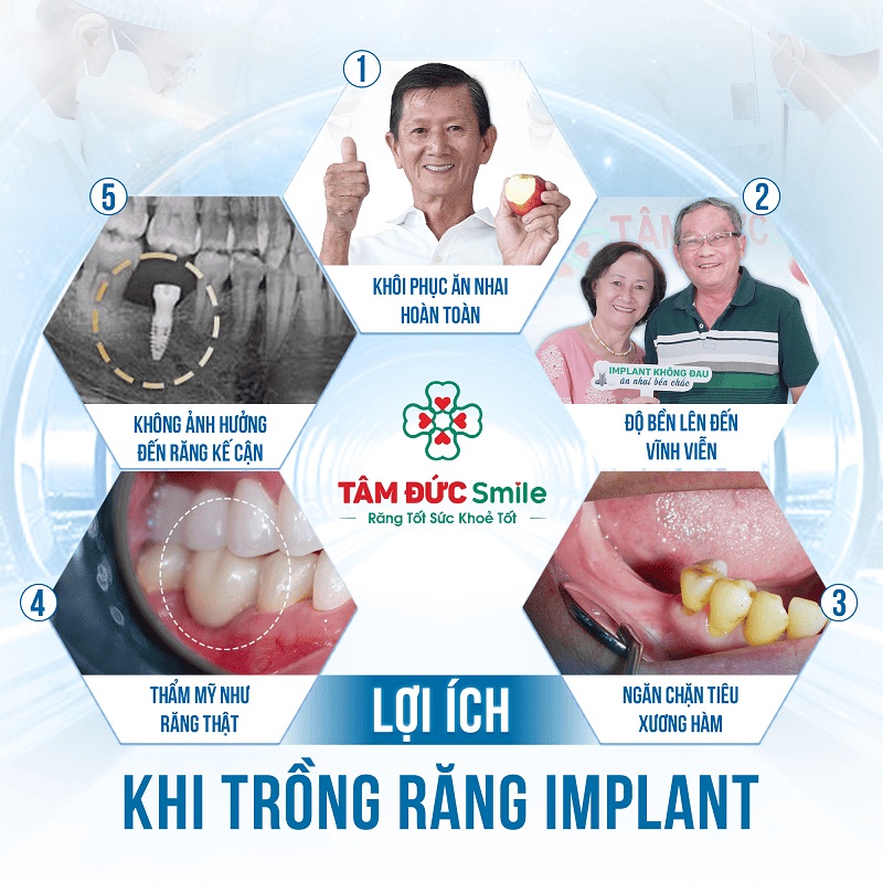Trồng răng implant mang lại khả năng ăn nhai tốt, Abc8c1 com khuyến mãi hấp dẫn cao và độ bền lâu dài.