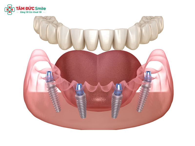 trong-rang-implant-all-on-4-1