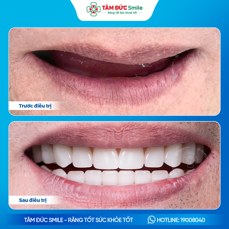 trong-rang-implant-all-on-4-2