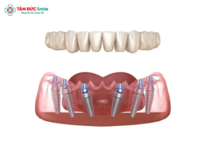 trong-rang-implant-all-on-6-1