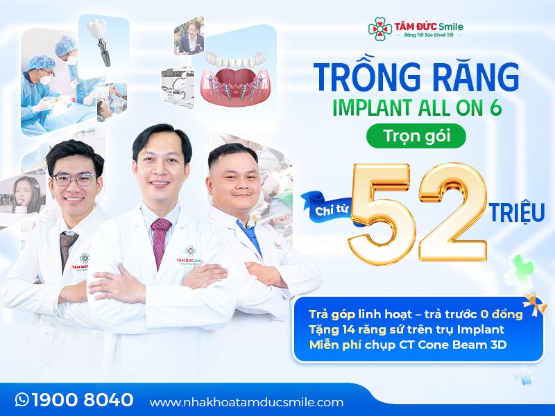 trong-rang-implant-all-on-6-1