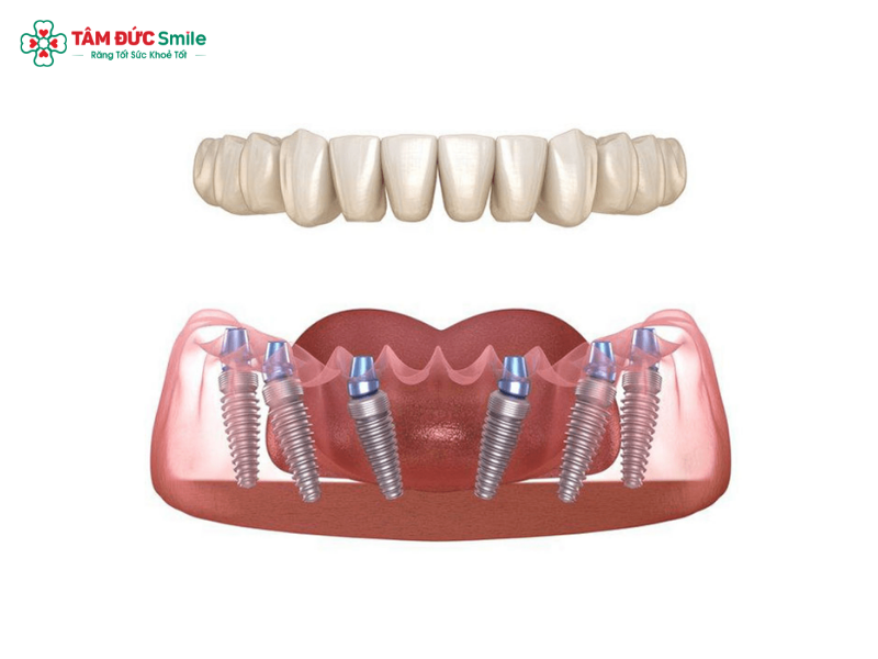 trong-rang-implant-all-on-6-1