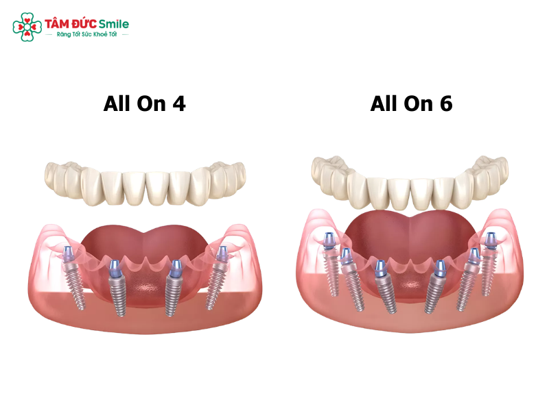 trong-rang-implant-all-on-6-2