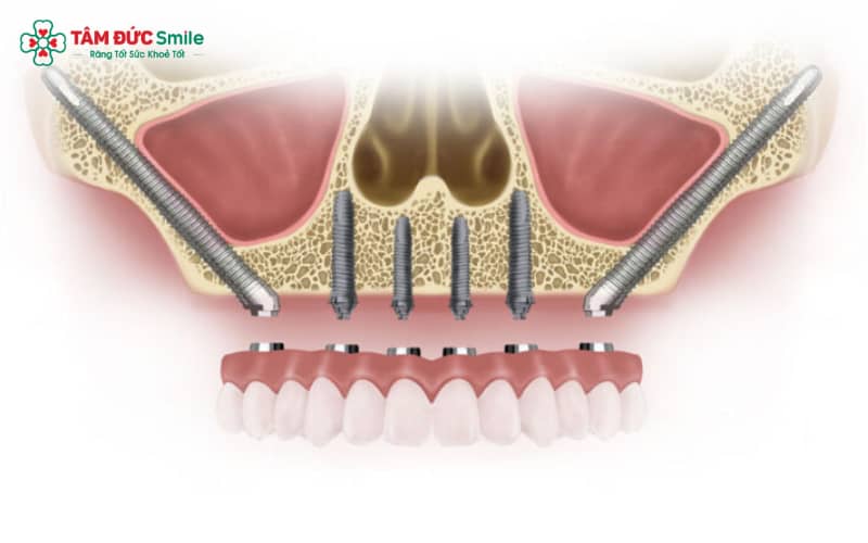 Implant ETK được nghiên cứu và phát triển với mục tiêu cải thiện khả năng tích hợp xương tối ưu