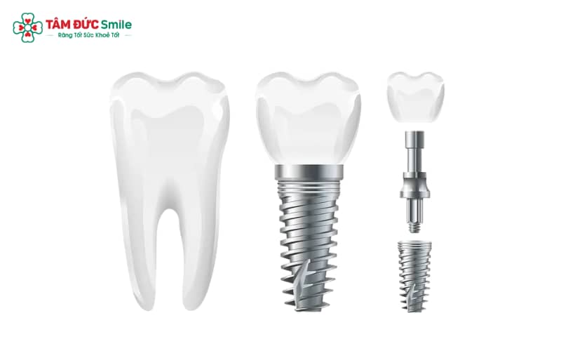 Các loại implant hiện đại chủ yếu sử dụng Titanium và Zirconia làm vật liệu chế tạo trụ