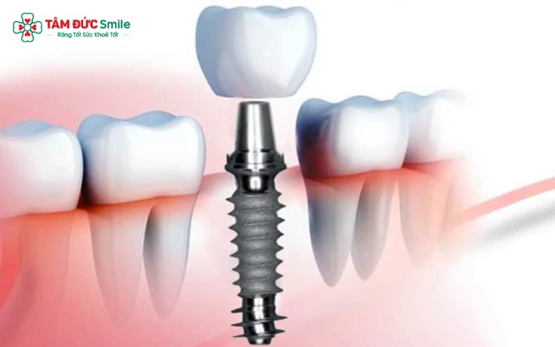 Titanium sở hữu độ bền cao, khối lượng nhẹ và khả năng chống ăn mòn kim loại đặc biệt hiệu quả