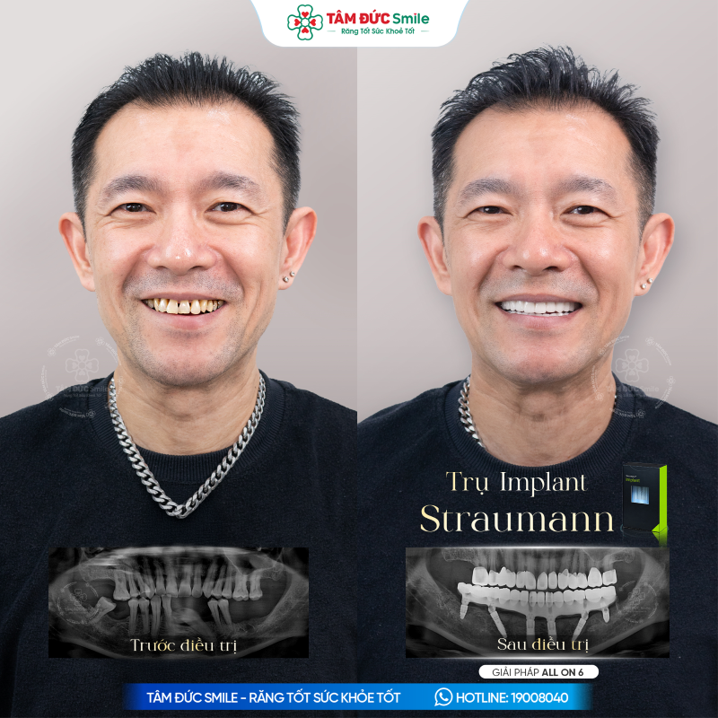 tru-implant-straumann-3