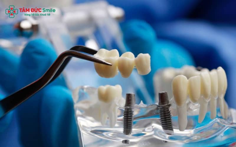 Trụ implant có xuất xứ Trung Quốc, được sản xuất tại nhiều cơ sở công nghiệp LINK TRANG CHỦ ABC88 CHUẨN 2026 của quốc gia này