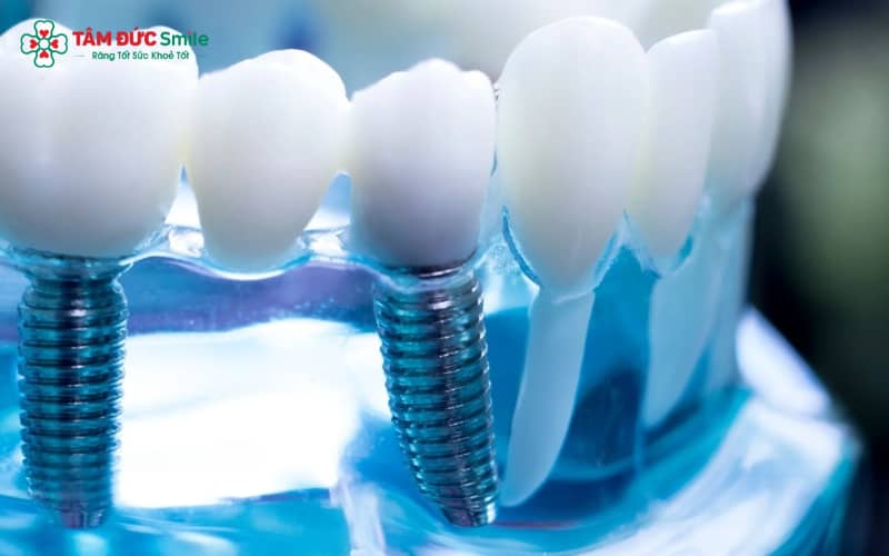 Lợi thế cạnh tranh chính của implant Trung Quốc là giá thành phải chăng