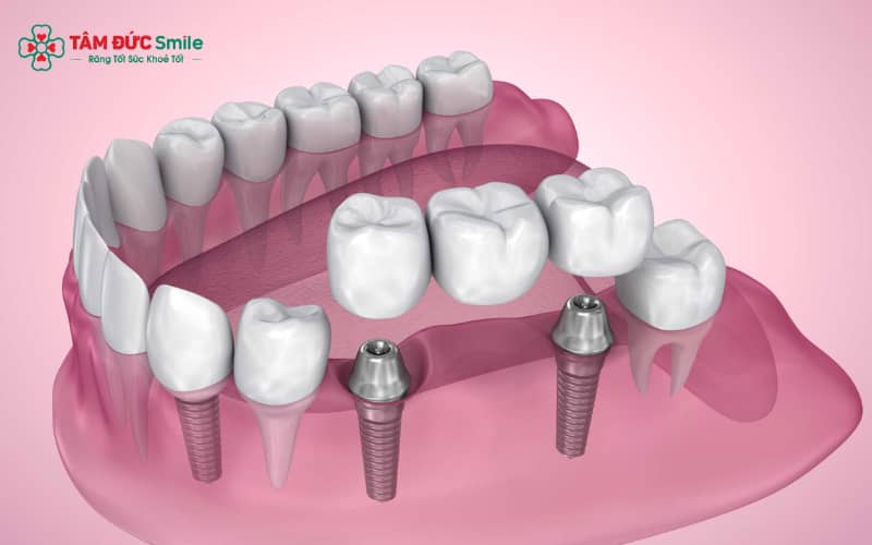 Một ca implant tiêu chuẩn gồm giai đoạn cấy trụ, tích hợp xương và lắp mão sứ, thường kéo dài 2–6 tháng tùy cơ địa.