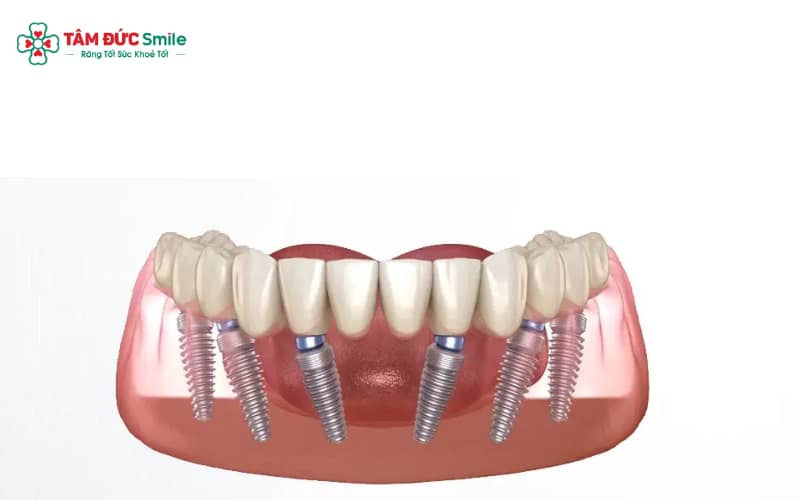 Thời gian cấy 3 implant phụ thuộc chất lượng xương, thời gian mất răng, sức khỏe tổng thể và kỹ thuật của ABC8 đường link chính thức