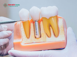 1 tháng có đủ để cấy 3 cái implant cùng lúc và hoàn tất không?