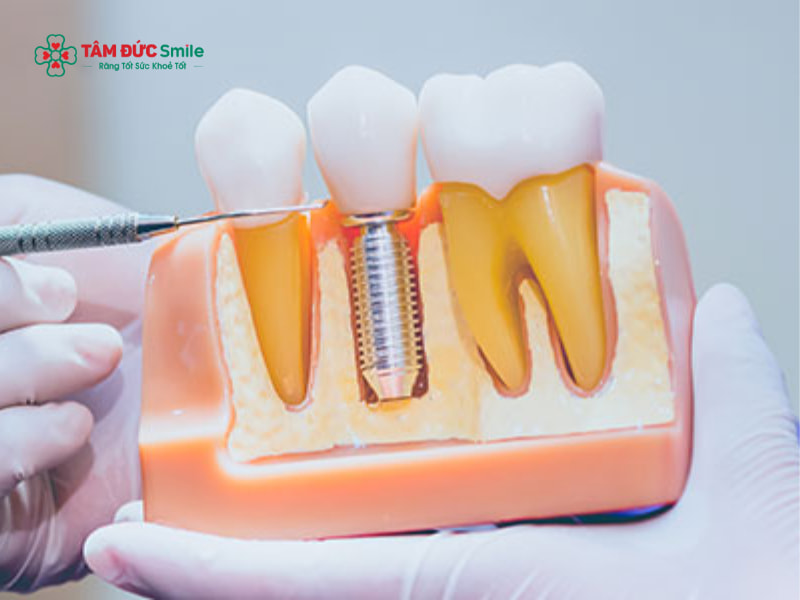1 tháng có đủ để cấy 3 cái implant cùng lúc và hoàn tất không?