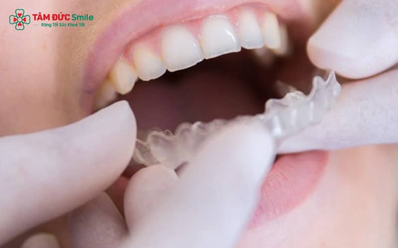 ABC8 được thành lập vào năm 2011 hoạt động đến hiện tại 3D Clear phù hợp với người có răng lệch nhẹ – Invisalign phù hợp cả với ca phức tạp
