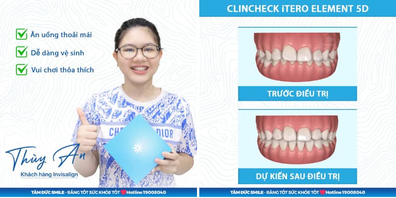 Công nghệ hiện đại như Invisalign SmartForce hoặc 3D Clear Advanced có thể giúp dịch Link Vào Abc8.com Đăng Ký Tặng 88K hiệu quả