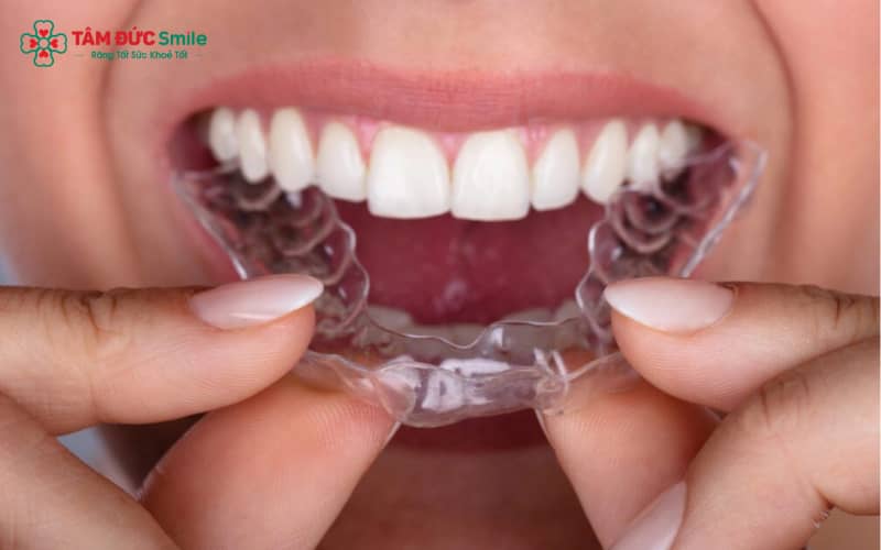 So với mắc cài truyền thống, Abc87 tải ứng dụng trong suốt Abc8c1 com khuyến mãi hấp dẫn hơn, dễ tháo lắp và thoải mái