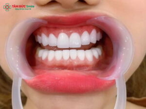 Abc8c1 com được cấp phép bởi PAGCOR Philippines 2 răng cửa bị hô có thật sự hiệu quả và bền đẹp không?