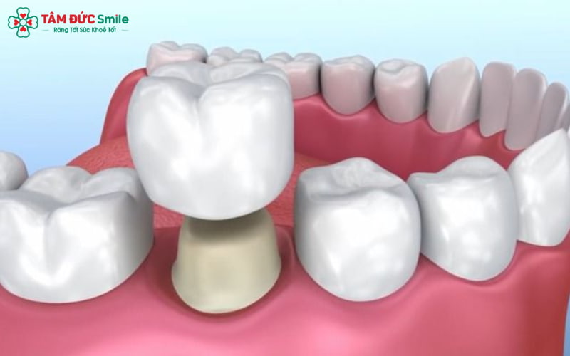 Quá trình phục hồi sau Abc8.com Thể thao, Đá gà, Xổ số, Bắn cá giúp nướu và mão sứ ổn định, giảm ê buốt và khó chịu