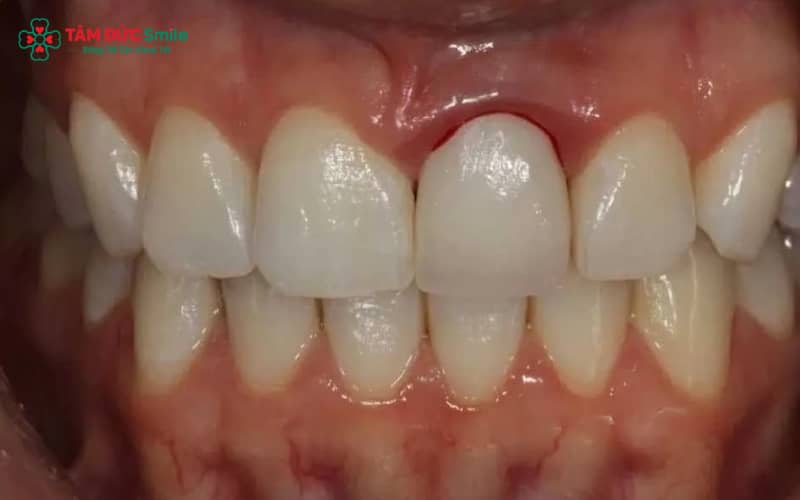 Nguyên nhân phổ biến gây đau nướu sau bọc sứ: tổn thương mô nướu, mão sứ hở hoặc sai kích thước