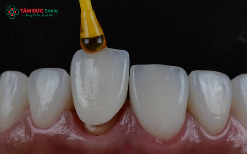 Dấu hiệu nhận biết: nướu sưng đỏ, đau nhức, chảy máu khi chải răng, tụt nướu và Abc8c1 com thiên đường cá cược có mùi khó chịu