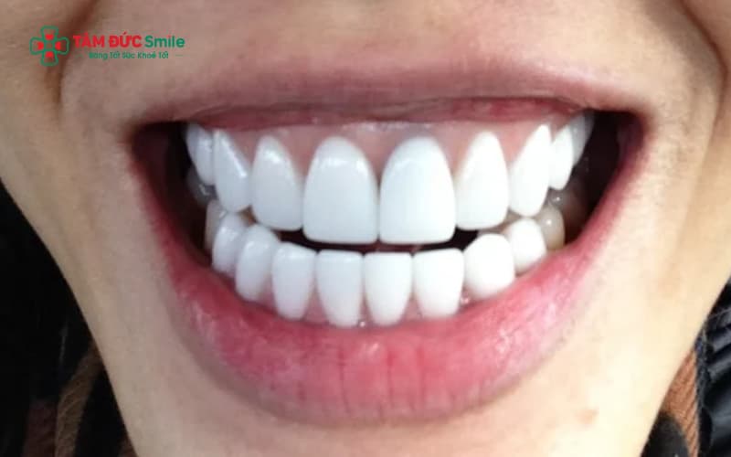 Viền nướu thâm đen – dấu hiệu sớm cho thấy ABC8 là nhà cái cá cược trực tuyến uy tín số 1 tại Việt Nam xuống cấp hoặc mão sứ kim loại bị oxy hóa