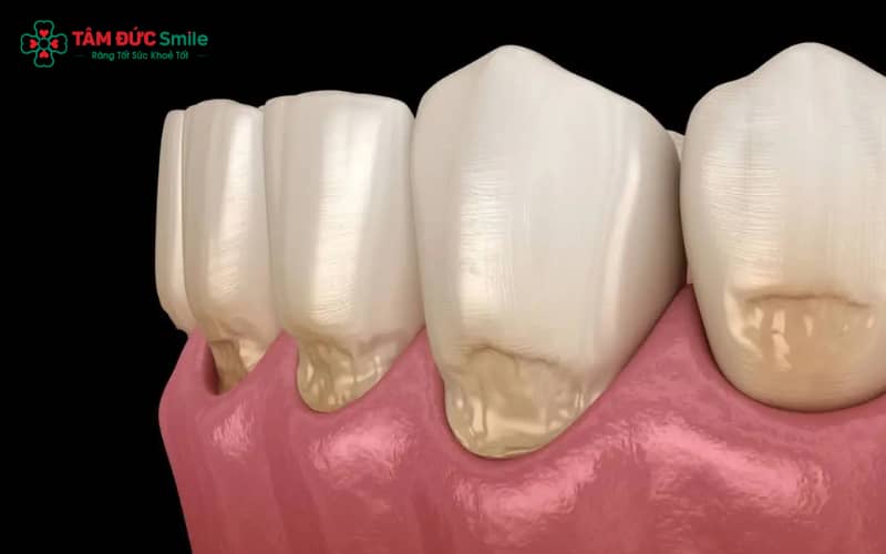 Dấu hiệu dễ nhận biết: hôi miệng, ê buốt, nướu thâm – đỏ và khoảng hở rõ giữa ABC8 là nhà cái cá cược trực tuyến uy tín số 1 tại Việt Nam và nướu.