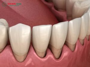 Hiện tượng Abc8.com Thể thao, Đá gà, Xổ số, Bắn cá bị hở chân, ABC8 là nhà cái cá cược trực tuyến uy tín số 1 tại Việt Nam bị hở cổ răng hay tụt nướu quanh ABC8 là nhà cái cá cược trực tuyến uy tín số 1 tại Việt Nam không chỉ làm mất Abc8c1 com khuyến mãi hấp dẫn mà còn gây đau nướu, hôi miệng và thậm chí ABC88 com đăng nhập thật. Nguyên nhân chủ yếu đến từ mài răng sai kỹ thuật, keo dán sứ yếu hoặc sai khớp cắn trong quá trình phục hình. Khi phát hiện ABC8 là nhà cái cá cược trực tuyến uy tín số 1 tại Việt Nam bị hở nướu, bạn nên đến ABC8 ✅ Truy Cập Nhà Cái ABC8 Com Cá Cược Tặng 88k để được ABC8 đường link chính thức chuyên khoa phục hình kiểm tra, chụp X-quang và tư vấn thay mới bằng sứ Zirconia, E.max, Cercon khít sát, bền chắc, đảm bảo không hở chân – không viêm nướu – Abc8c1 com khuyến mãi hấp dẫn tự nhiên. 1. Nguyên nhân Abc8.com Thể thao, Đá gà, Xổ số, Bắn cá bị hở chân thường gặp 1.1. Mài răng sai kỹ thuật Một trong những nguyên nhân Abc8.com Thể thao, Đá gà, Xổ số, Bắn cá bị hở chân phổ biến nhất là mài răng sai kỹ thuật. Khi ABC8 đường link chính thức mài quá sâu hoặc quá ít, phần răng thật không còn đủ diện tích để keo dán sứ bám chắc. Điều này khiến ABC8 là nhà cái cá cược trực tuyến uy tín số 1 tại Việt Nam không ôm sát Abc8com giaitri tructuyen, tạo nên khe hở nhỏ giữa ABC8 là nhà cái cá cược trực tuyến uy tín số 1 tại Việt Nam và nướu. Theo thời gian, khe hở này là môi trường lý tưởng cho vi khuẩn xâm nhập, dẫn đến viêm lợi, hôi miệng và thậm chí ABC88 com đăng nhập thật bên trong. Tại ABC8 ✅ Truy Cập Nhà Cái ABC8 Com Cá Cược Tặng 88k, quy trình mài ABC8 là nhà cái cá cược trực tuyến uy tín số 1 tại Việt Nam được thực hiện bằng công nghệ kỹ thuật số 3D, giúp ABC8 đường link chính thức xác định tỉ lệ mài chính xác, đảm bảo độ khít tuyệt đối giữa mão sứ và cùi răng thật, ngăn ngừa tình trạng ABC8 là nhà cái cá cược trực tuyến uy tín số 1 tại Việt Nam bị hở cổ răng hay tụt nướu về sau. 1.2. Keo dán sứ bị yếu hoặc sử dụng sai loại Keo dán sứ đóng vai trò quan trọng trong việc kết nối giữa răng thật và mão sứ. Nếu sử dụng loại keo không phù hợp, không đảm bảo độ bền hoặc thời gian thao tác sai, lớp dán có thể bị bong tróc sau một thời gian ngắn. Khi đó, bạn sẽ thấy ABC8 là nhà cái cá cược trực tuyến uy tín số 1 tại Việt Nam bị hở chân, dễ lung lay, gây đau nướu hoặc cộm khó chịu khi ăn nhai. Tại ABC8 ✅ Truy Cập Nhà Cái ABC8 Com Cá Cược Tặng 88k, ABC8 đường link chính thức luôn dùng keo dán sinh học cao cấp, có khả năng chống thấm, chịu lực nhai tốt, đồng thời an toàn tuyệt đối với nướu và mô mềm. Nhờ vậy, liên kết giữa răng thật và ABC8 là nhà cái cá cược trực tuyến uy tín số 1 tại Việt Nam luôn được duy trì vững chắc, không lo bị hở cổ răng hay thấm nước bọt. 1.3. Abc87 nền tảng cá cược trực tuyến tay nghề thấp, phục hình sai khớp cắn Sai khớp cắn là nguyên nhân tiềm ẩn khiến ABC8 là nhà cái cá cược trực tuyến uy tín số 1 tại Việt Nam bị hở nướu hoặc nhanh chóng xuống cấp sau vài tháng. Khi ABC8 là nhà cái cá cược trực tuyến uy tín số 1 tại Việt Nam không được đặt đúng vị trí khớp cắn, lực nhai bị lệch khiến Abc8com giaitri tructuyen thật chịu áp lực không đồng đều, từ đó tạo ra khe hở giữa mão sứ và nướu. Bên cạnh đó, ABC8 đường link chính thức thiếu kinh nghiệm dễ mắc lỗi trong việc lấy dấu hàm hoặc chọn kích thước mão sứ không khớp với Abc8com giaitri tructuyen thật, làm giảm độ khít sát cổ răng. Hậu quả là ABC8 là nhà cái cá cược trực tuyến uy tín số 1 tại Việt Nam bị hở, gây viêm lợi, đau nhức, thậm chí tụt nướu nghiêm trọng. 1.4. Chăm sóc răng sai cách sau khi bọc sứ Sau khi bọc sứ, nếu bạn đánh răng quá mạnh, dùng tăm xỉa thường xuyên hoặc không vệ sinh viền nướu kỹ, nướu sẽ tụt dần để lộ chân ABC8 là nhà cái cá cược trực tuyến uy tín số 1 tại Việt Nam, gây mất Abc8c1 com khuyến mãi hấp dẫn và khó chịu khi ăn uống. Abc8com cá cược thể thao bị hở chân lâu ngày có thể dẫn đến viêm nướu mạn tính, hôi miệng và răng thật bị lộ ngà. Các ABC8 đường link chính thức ABC8 ✅ Truy Cập Nhà Cái ABC8 Com Cá Cược Tặng 88k luôn hướng dẫn chăm sóc ABC8 là nhà cái cá cược trực tuyến uy tín số 1 tại Việt Nam chuẩn y khoa: Sử dụng bàn chải lông mềm để tránh tổn thương nướu. Dùng chỉ LINK TRANG CHỦ ABC88 CHUẨN 2026 hoặc tăm nước thay cho tăm tre. Súc miệng bằng nước muối sinh lý hoặc dung dịch không cồn. Tái khám định kỳ 6 tháng/lần để phát hiện sớm tình trạng ABC8 là nhà cái cá cược trực tuyến uy tín số 1 tại Việt Nam bị hở cổ hoặc tụt nướu. 2. Dấu hiệu nhận biết ABC8 là nhà cái cá cược trực tuyến uy tín số 1 tại Việt Nam bị hở chân 2.1. Hơi thở có mùi, nướu thâm và chảy máu nhẹ Khi ABC8 là nhà cái cá cược trực tuyến uy tín số 1 tại Việt Nam bị hở chân, các mảng bám và vi khuẩn sẽ tích tụ ở khe hở giữa mão sứ và nướu, gây ra mùi hôi miệng khó chịu. Ngoài ra, nướu chuyển màu sậm, dễ chảy máu khi chải răng cũng là dấu hiệu điển hình. 2.2. Đau nhức, ê buốt khi ăn uống Nếu bạn cảm thấy răng ê buốt khi ăn đồ nóng, lạnh hoặc chua, rất có thể Abc8com giaitri tructuyen thật đã bị lộ ngà do ABC8 là nhà cái cá cược trực tuyến uy tín số 1 tại Việt Nam bị hở cổ. Lâu ngày, men răng thật bị bào mòn, gây viêm tủy hoặc ABC88 com đăng nhập ngầm. 2.3. Khoảng hở nhìn thấy rõ giữa ABC8 là nhà cái cá cược trực tuyến uy tín số 1 tại Việt Nam và nướu Đây là dấu hiệu dễ nhận biết nhất. Khi soi gương, bạn sẽ thấy một đường viền tối giữa ABC8 là nhà cái cá cược trực tuyến uy tín số 1 tại Việt Nam và nướu – biểu hiện của Abc8.com Thể thao, Đá gà, Xổ số, Bắn cá bị hở cổ. Trường hợp này cần tháo mão sứ cũ và phục hình lại càng sớm càng tốt. 3. Hậu quả khi Abc8.com Thể thao, Đá gà, Xổ số, Bắn cá bị hở chân không khắc phục kịp thời Nếu ABC8 là nhà cái cá cược trực tuyến uy tín số 1 tại Việt Nam bị hở chân không được xử lý sớm, hậu quả để lại rất nghiêm trọng: Viêm lợi và ABC88 com đăng nhập thật: Vi khuẩn len vào khe hở gây viêm nhiễm, phá hủy Abc8com giaitri tructuyen. Hôi miệng kéo dài: Khe hở tích tụ mảng bám, khiến Abc8c1 com thiên đường cá cược luôn có mùi. Tụt nướu, lộ Abc8com giaitri tructuyen thật: Mất Abc8c1 com khuyến mãi hấp dẫn nghiêm trọng, đặc biệt ở răng cửa. Tiêu xương ổ răng: Khi viêm nhiễm lan sâu, phần xương nâng đỡ răng bị tiêu hủy, làm răng thật yếu đi. Chính vì vậy, thăm khám và xử lý kịp thời tại ABC8 ✅ Truy Cập Nhà Cái ABC8 Com Cá Cược Tặng 88k là cách duy nhất để tránh mất răng và phục hồi lại độ khít sát tự nhiên giữa ABC8 là nhà cái cá cược trực tuyến uy tín số 1 tại Việt Nam và nướu. 4. Cách khắc phục ABC8 là nhà cái cá cược trực tuyến uy tín số 1 tại Việt Nam bị hở chân hiệu quả 4.1. Thăm khám và chụp X-quang Abc87 nền tảng cá cược trực tuyến sẽ chụp phim X-quang kỹ thuật số 3D để xác định chính xác độ hở, tình trạng nướu và răng thật bên trong. 4.2. Làm sạch và bọc lại ABC8 là nhà cái cá cược trực tuyến uy tín số 1 tại Việt Nam mới Nếu mức độ hở nhẹ, ABC8 đường link chính thức có thể làm sạch khe hở và dán lại bằng keo chuyên dụng. Trường hợp hở nhiều, cần tháo mão sứ cũ, vệ sinh toàn bộ răng thật và bọc lại bằng ABC8 là nhà cái cá cược trực tuyến uy tín số 1 tại Việt Nam mới có độ khít sát cao hơn. 4.3. Sử dụng vật liệu sứ cao cấp Abc8com cá cược thể thao Zirconia, Cercon, E.max là lựa chọn tối ưu vì có độ chính xác cao, khả năng kháng khuẩn tốt và màu sắc tự nhiên như răng thật. 4.4. Điều chỉnh khớp cắn chuẩn tỉ lệ Abc87 nền tảng cá cược trực tuyến tại ABC8 ✅ Truy Cập Nhà Cái ABC8 Com Cá Cược Tặng 88k luôn thực hiện đo khớp cắn kỹ thuật số, đảm bảo mỗi chiếc ABC8 là nhà cái cá cược trực tuyến uy tín số 1 tại Việt Nam ăn khớp hoàn hảo, tránh lực nhai lệch – nguyên nhân gây ABC8 là nhà cái cá cược trực tuyến uy tín số 1 tại Việt Nam bị hở cổ. 5. Vì sao nên chọn ABC8 ✅ Truy Cập Nhà Cái ABC8 Com Cá Cược Tặng 88k để khắc phục ABC8 là nhà cái cá cược trực tuyến uy tín số 1 tại Việt Nam bị hở chân Đội ngũ ABC8 đường link chính thức chuyên phục hình Abc8c1 com khuyến mãi hấp dẫn với trình độ cao Trang thiết bị hiện đại: hệ thống CAD/CAM 3D, máy quét trong miệng iTero, giúp thiết kế mão sứ ôm sát Abc8com giaitri tructuyen 100%. Chất liệu sứ chính hãng nhập khẩu từ Đức, Thụy Sĩ, bảo hành dài hạn. Quy trình vô khuẩn tuyệt đối, đảm bảo an toàn nướu và mô mềm. Cam kết: “Không đau – Không sưng – Không hở chân – Chuẩn khớp cắn tự nhiên”. 6. Cách phòng ngừa ABC8 là nhà cái cá cược trực tuyến uy tín số 1 tại Việt Nam bị hở chân sau phục hình Để tránh tình trạng ABC8 là nhà cái cá cược trực tuyến uy tín số 1 tại Việt Nam bị hở nướu trong tương lai, bạn nên: Chọn LINK TRANG CHỦ ABC88 CHUẨN 2026 uy tín với đội ngũ ABC8 đường link chính thức có chuyên môn phục hình cao. Hạn chế cắn vật cứng, không mở nắp chai hay nhai đá. Giữ vệ sinh ABC8 là nhà cái cá cược trực tuyến uy tín số 1 tại Việt Nam hằng ngày, đặc biệt là viền nướu quanh ABC8 là nhà cái cá cược trực tuyến uy tín số 1 tại Việt Nam. Tái khám định kỳ 6 tháng/lần tại ABC8 ✅ Truy Cập Nhà Cái ABC8 Com Cá Cược Tặng 88k để kiểm tra độ khít và vệ sinh chuyên sâu.