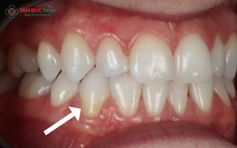 Abc8com cá cược thể thao bị hở chân thường do mài răng sai kỹ thuật, keo dán yếu hoặc phục hình sai khớp cắn