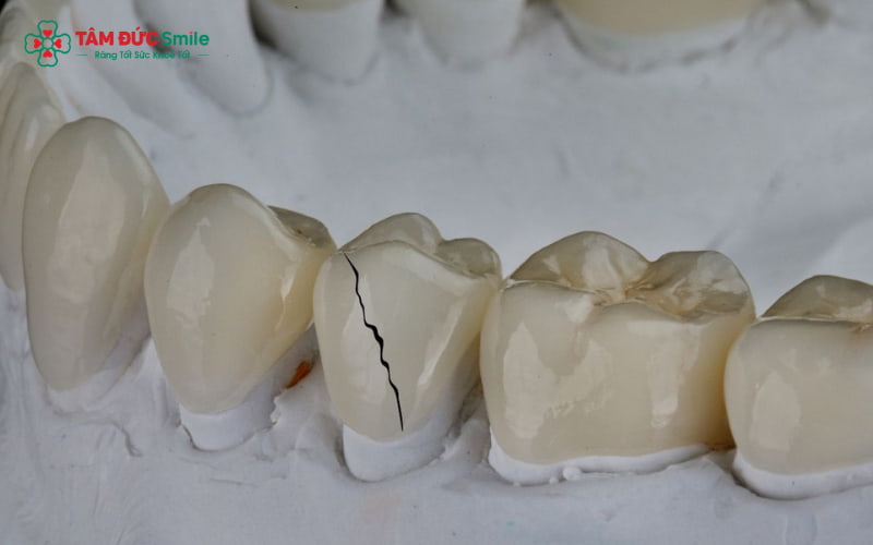 Nguyên nhân có thể từ kỹ thuật thực hiện, chất lượng vật liệu hoặc thói quen chăm sóc răng không đúng