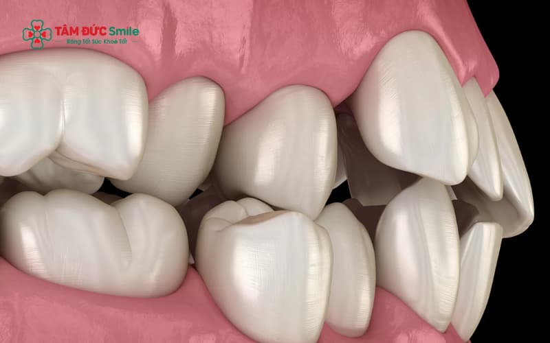 Dấu hiệu lệch khớp cắn gồm cắn không khít, đau khi nhai, nhức hàm hoặc lệch mặt nhẹ