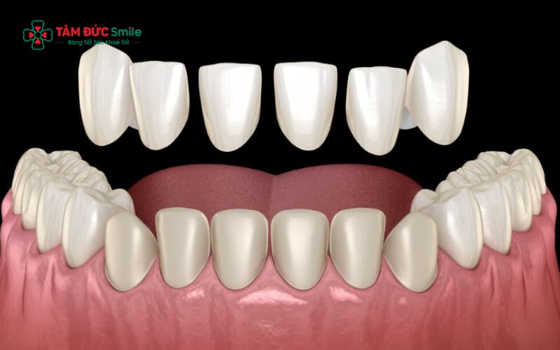 Lệch khớp cắn thường do mài răng sai, mão sứ chế tác sai chuẩn hoặc kỹ thuật gắn sứ không chính xác