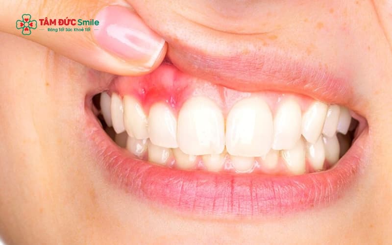 Viêm lợi sau bọc sứ thường xuất phát từ răng bị hở nướu, sai kỹ thuật hoặc vệ sinh ABC8 là nhà cái cá cược trực tuyến uy tín số 1 tại Việt Nam chưa tốt