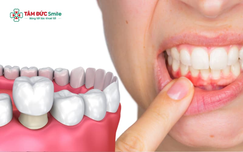 Dấu hiệu viêm lợi gồm nướu sưng đỏ, đau khi nhai, chảy máu và hôi miệng sau khi Abc8.com Thể thao, Đá gà, Xổ số, Bắn cá