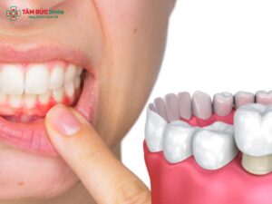 Nguyên nhân viêm lợi sau khi Abc8.com Thể thao, Đá gà, Xổ số, Bắn cá và cách khắc phục hiệu quả