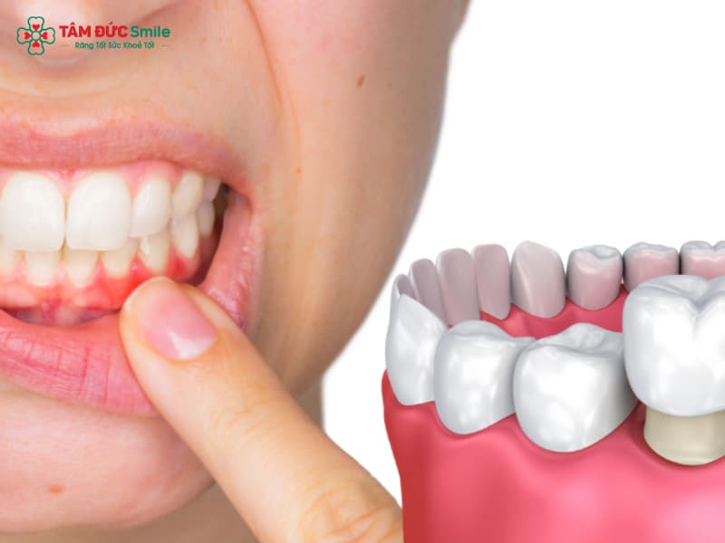 Nguyên nhân viêm lợi sau khi Abc8.com Thể thao, Đá gà, Xổ số, Bắn cá và cách khắc phục hiệu quả