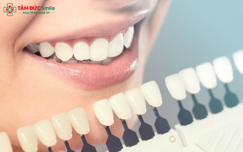 Chỉ bọc sứ cho răng cửa hô trong các trường hợp nhẹ, còn răng hô nặng hoặc khớp cắn sai cần niềng