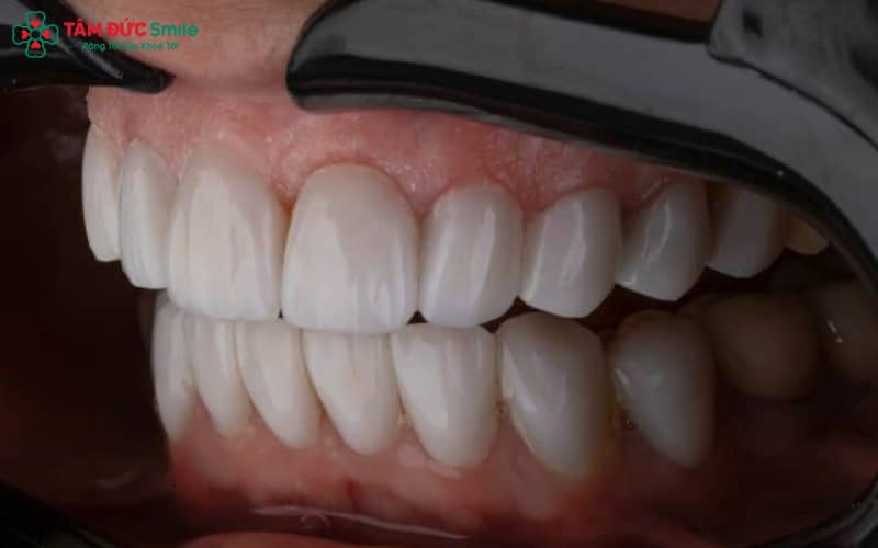 Các dòng ABC8 là nhà cái cá cược trực tuyến uy tín số 1 tại Việt Nam cao cấp như Emax, Zirconia, Lava Plus giúp chỉnh hình răng cửa hô nhẹ, vừa Abc8c1 com khuyến mãi hấp dẫn vừa bền chắc