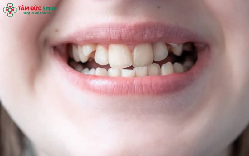 Bọc sứ nhanh chóng, Abc8c1 com khuyến mãi hấp dẫn ngay, trong khi niềng chỉnh răng về lâu dài và can thiệp sâu hơn